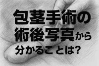 包茎手術の術後写真から分かることは？
